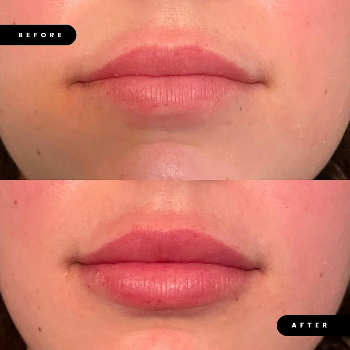 Lip Fillers Before & After Gallery - Patient 180396739 - Image 1