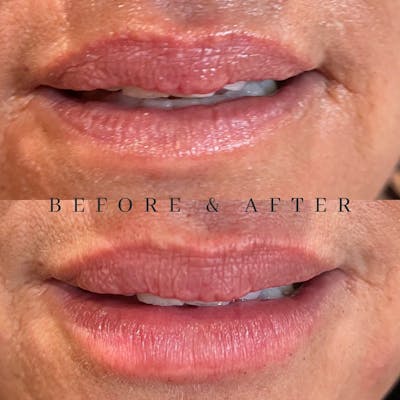 Lip Fillers Before & After Gallery - Patient 180396743 - Image 1