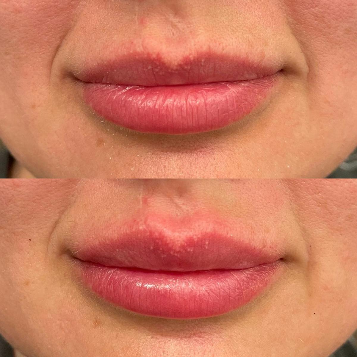 Lip Fillers Before & After Gallery - Patient 180396757 - Image 1