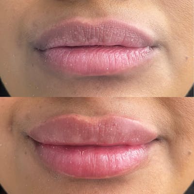 Lip Fillers Before & After Gallery - Patient 180396758 - Image 1