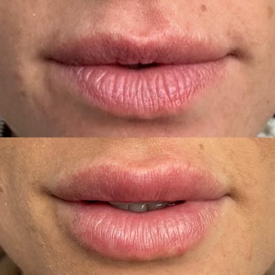 Lip Fillers Before & After Gallery - Patient 180396759 - Image 1