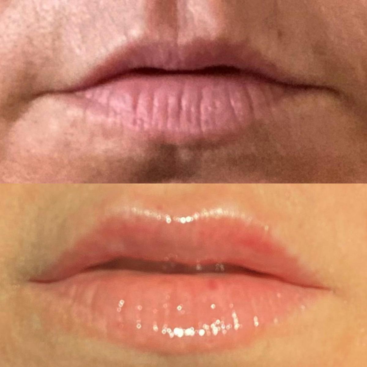 Lip Fillers Before & After Gallery - Patient 180396763 - Image 1