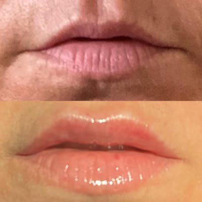 Lip Fillers Before & After Gallery - Patient 180396763 - Image 1