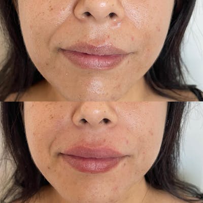 Tox and Fillers Before & After Gallery - Patient 180396797 - Image 1