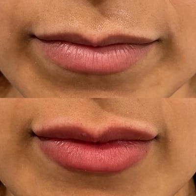 Lip Fillers Before & After Gallery - Patient 180396802 - Image 1