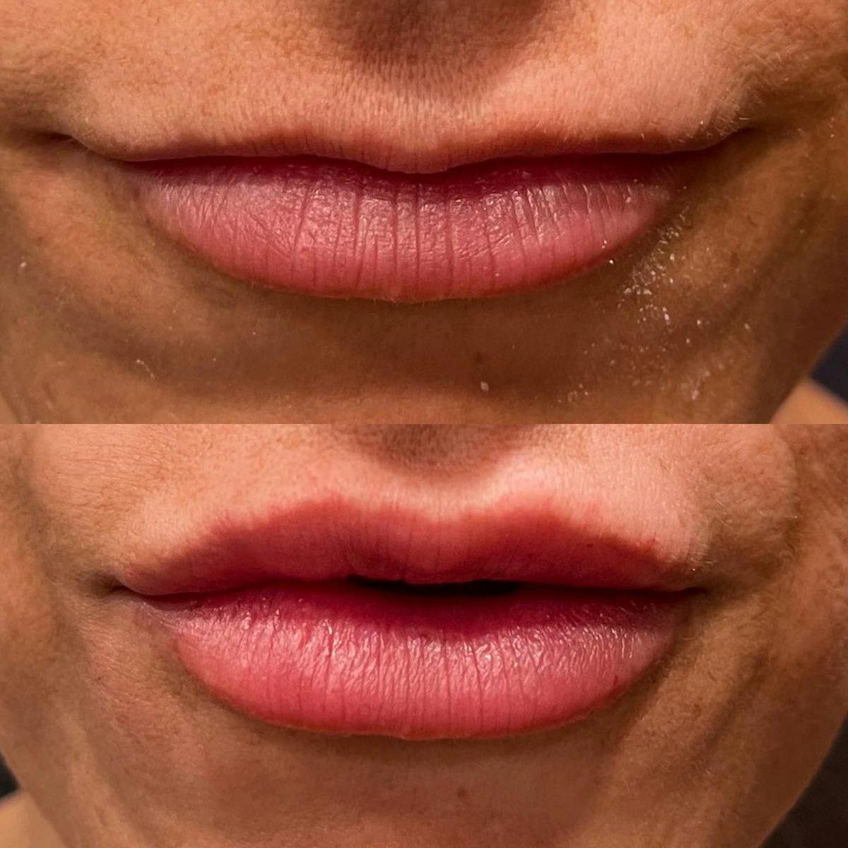 Lip Fillers Before & After Gallery - Patient 180396803 - Image 1
