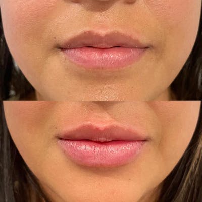 Lip Fillers Before & After Gallery - Patient 180396807 - Image 1