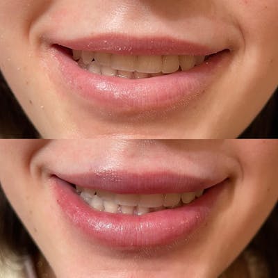 Lip Fillers Before & After Gallery - Patient 180396808 - Image 1