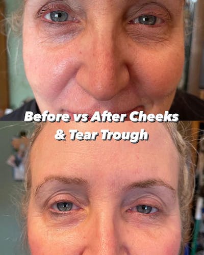 Tear Trough Fillers Before & After Gallery - Patient 180396811 - Image 1
