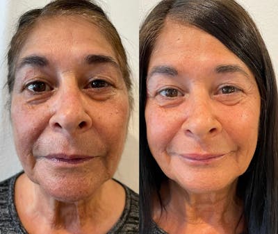 Facial Rejuvenation Before & After Gallery - Patient 180396822 - Image 1