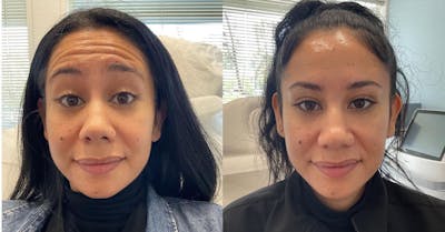 Wrinkle Relaxers Before & After Gallery - Patient 180396878 - Image 1