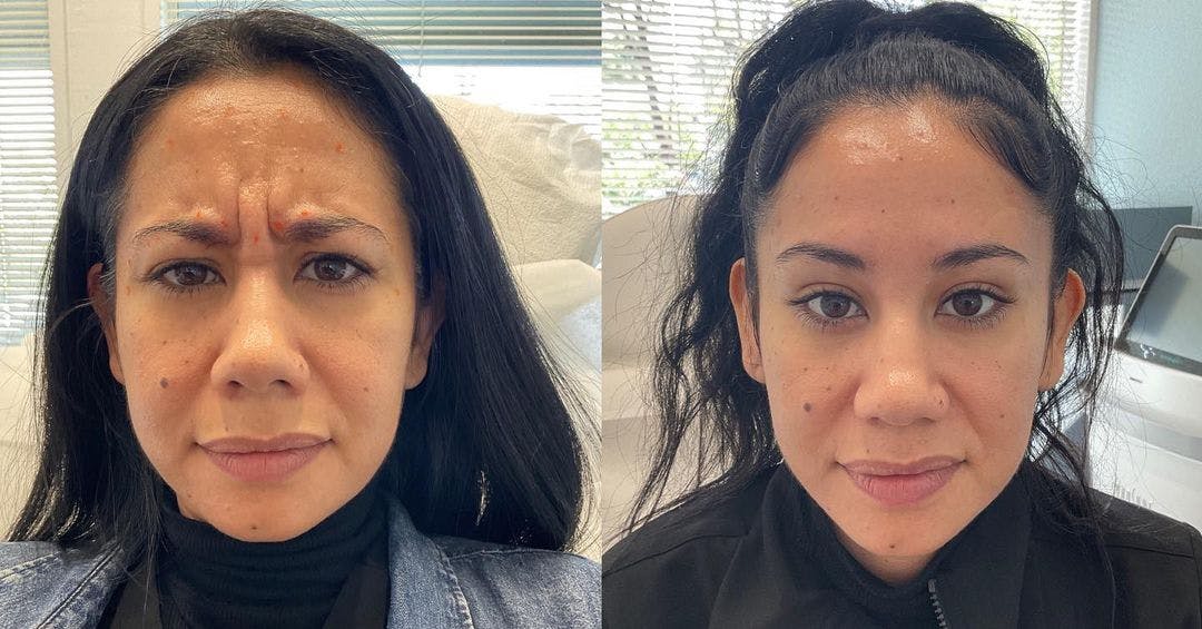 Wrinkle Relaxers Before & After Gallery - Patient 180396878 - Image 2