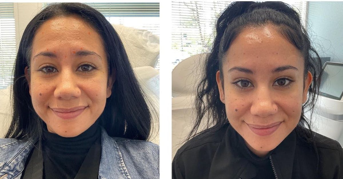Wrinkle Relaxers Before & After Gallery - Patient 180396878 - Image 3