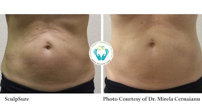 Sculpsure Before & After Gallery - Patient 179749793 - Image 1