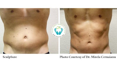 Sculpsure Before & After Gallery - Patient 179749794 - Image 1