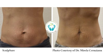 Sculpsure Before & After Gallery - Patient 179749795 - Image 1