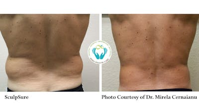 Sculpsure Before & After Gallery - Patient 179749796 - Image 1