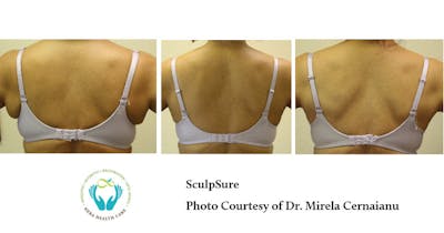 Sculpsure Before & After Gallery - Patient 179749798 - Image 1