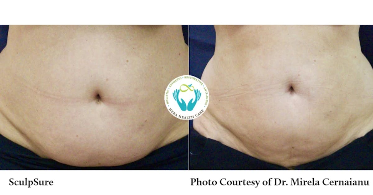 Sculpsure Before & After Gallery - Patient 179749800 - Image 1