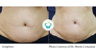 Sculpsure Before & After Gallery - Patient 179749800 - Image 1