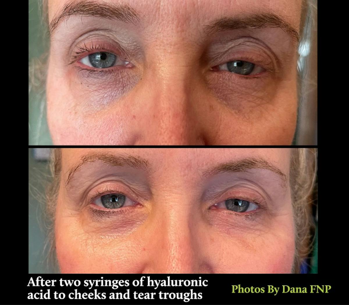 Tear Trough Fillers Before & After Gallery - Patient 180403379 - Image 1