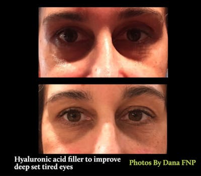 Tear Trough Fillers Before & After Gallery - Patient 180403388 - Image 1