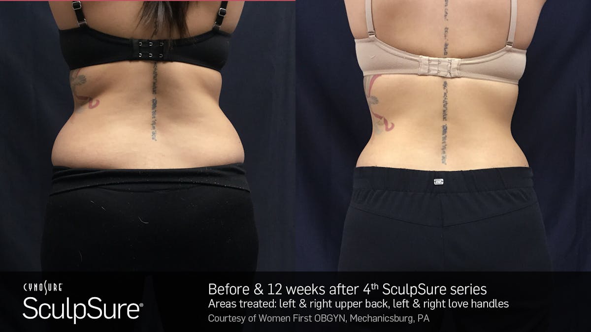Sculpsure Before & After Gallery - Patient 180403397 - Image 1