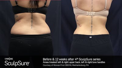 Sculpsure Before & After Gallery - Patient 180403397 - Image 1