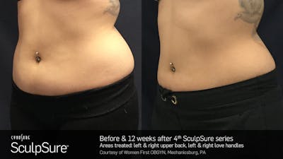 Sculpsure Before & After Gallery - Patient 180403398 - Image 1