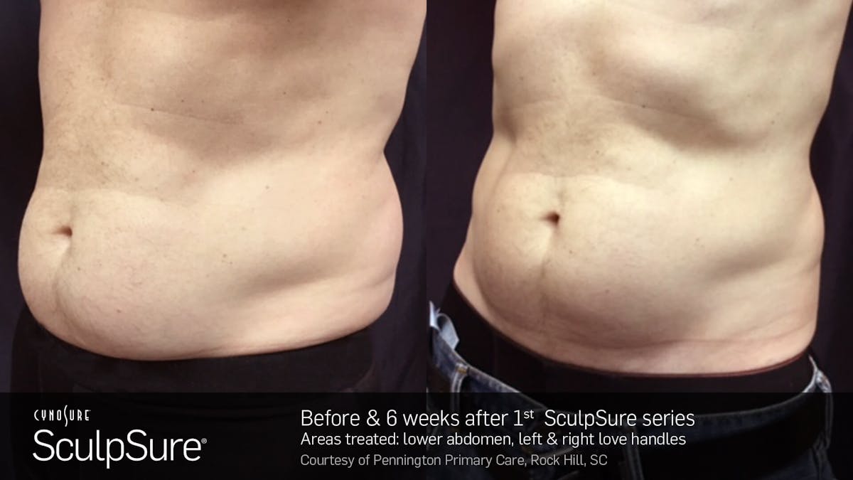 Sculpsure Before & After Gallery - Patient 180403399 - Image 1
