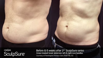 Sculpsure Before & After Gallery - Patient 180403399 - Image 1
