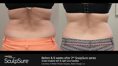Sculpsure Before & After Gallery - Patient 180403400 - Image 1