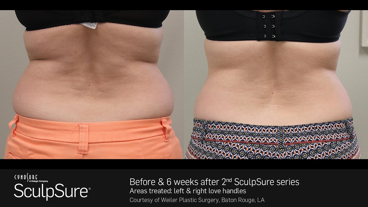 Sculpsure Before & After Gallery - Patient 180403400 - Image 1