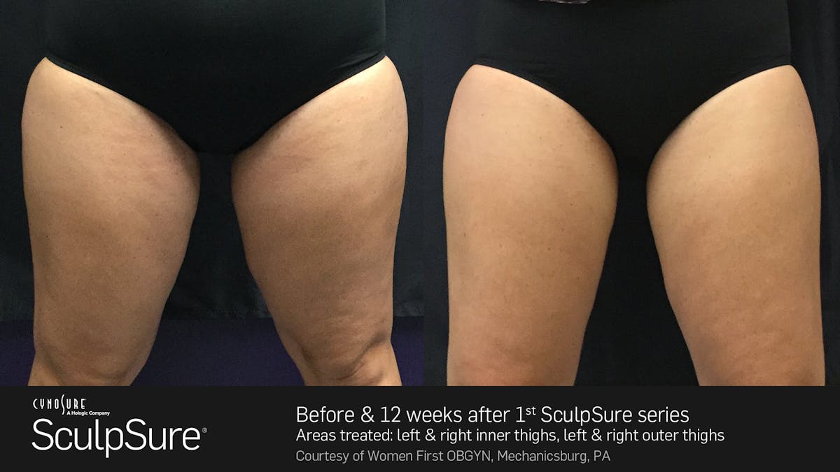 Sculpsure Before & After Gallery - Patient 180403401 - Image 1