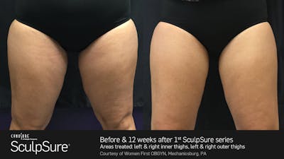 Sculpsure Before & After Gallery - Patient 180403401 - Image 1