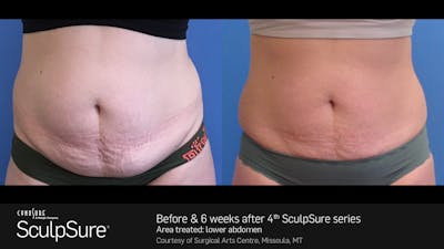 Sculpsure Before & After Gallery - Patient 180403402 - Image 1