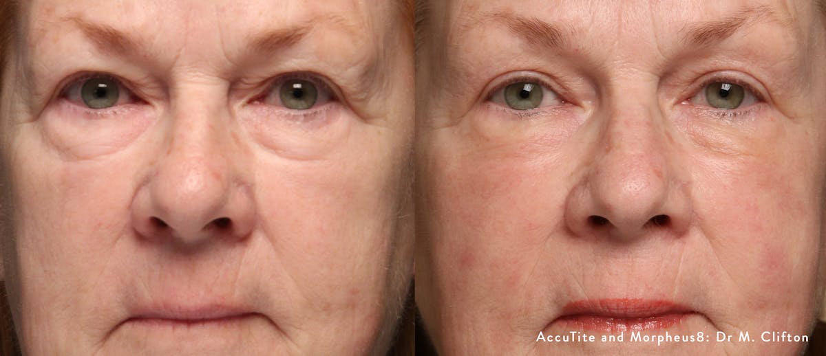 Morpheus8 Before & After Gallery - Patient 180403409 - Image 1