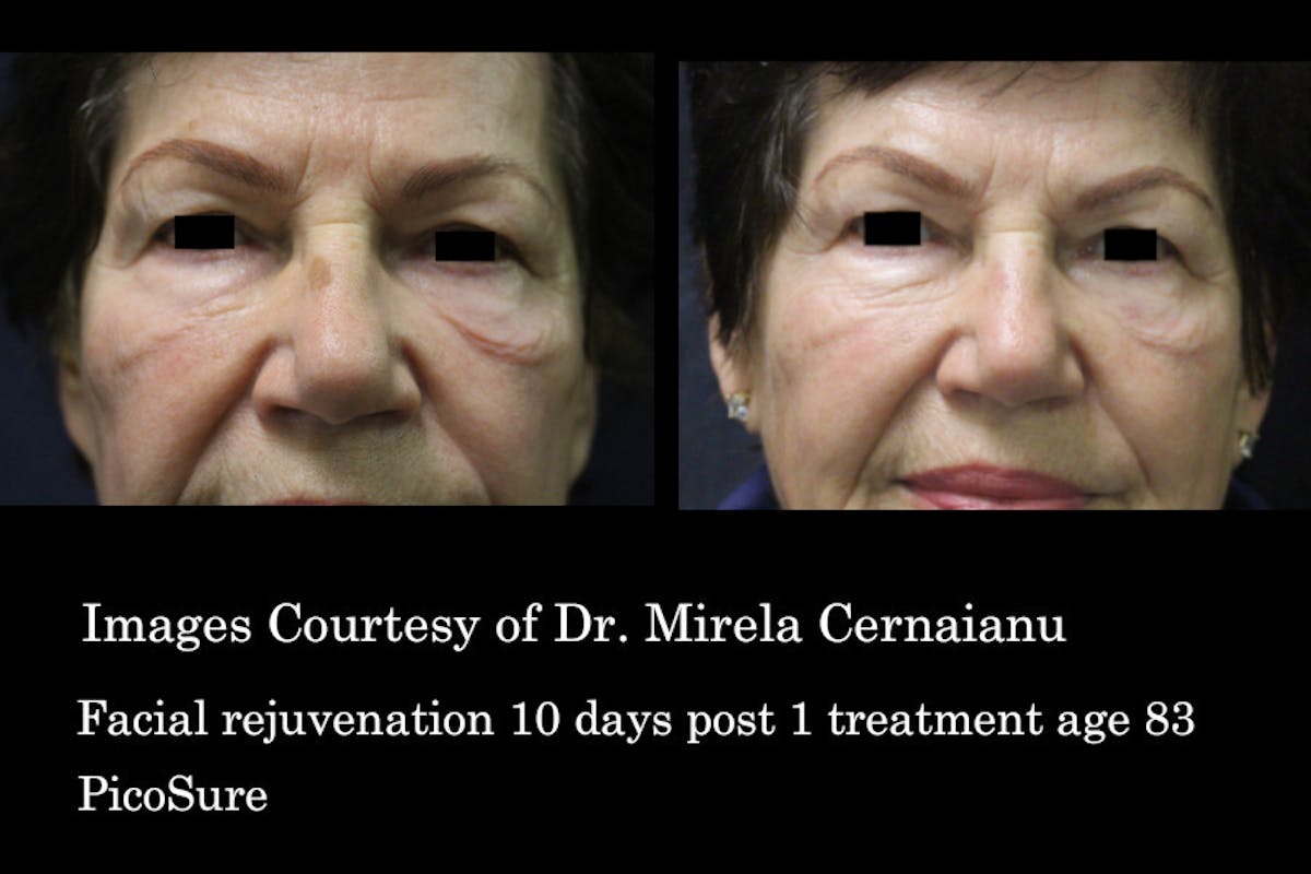 PicoSure Before & After Gallery - Patient 179749787 - Image 1