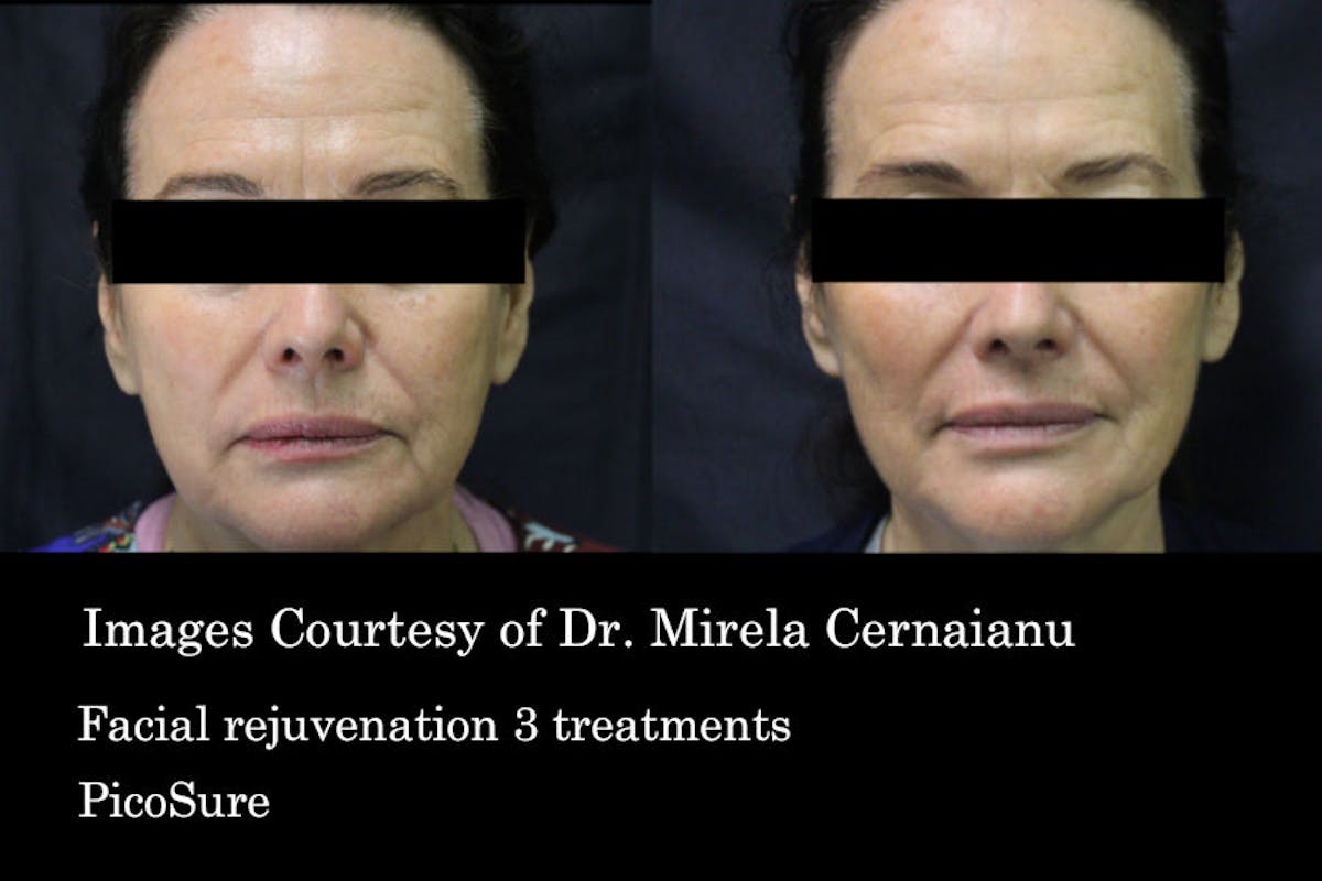 PicoSure Before & After Gallery - Patient 179749790 - Image 1