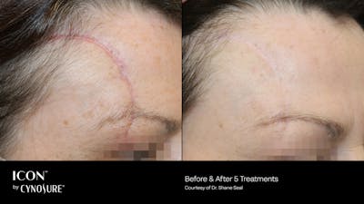 ICON™ Before & After Gallery - Patient 180415433 - Image 1