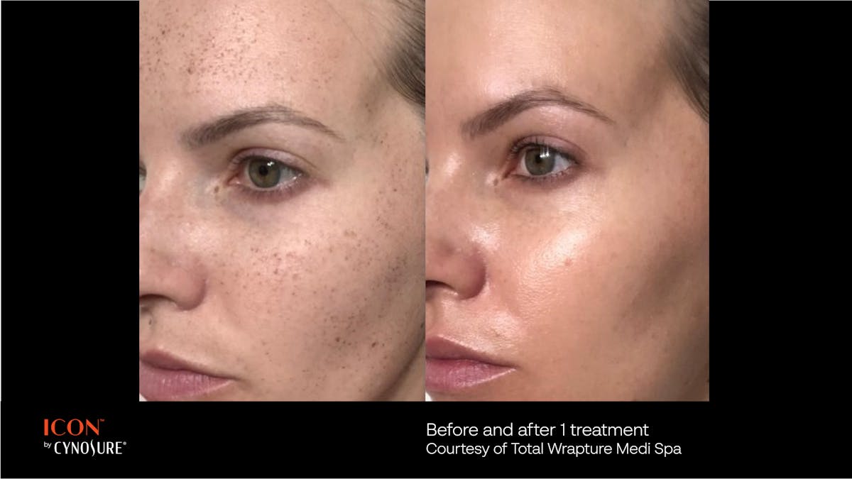 ICON™ Before & After Gallery - Patient 180415437 - Image 1