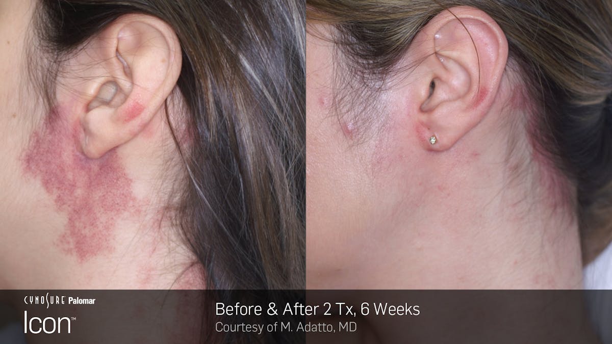 ICON™ Before & After Gallery - Patient 180415472 - Image 1