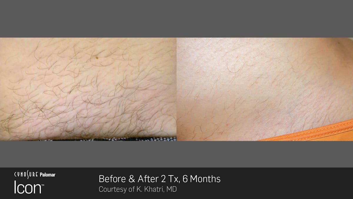 Laser Hair Removal Before & After Gallery - Patient 180415496 - Image 1