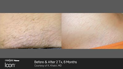 Laser Hair Removal Before & After Gallery - Patient 180415496 - Image 1