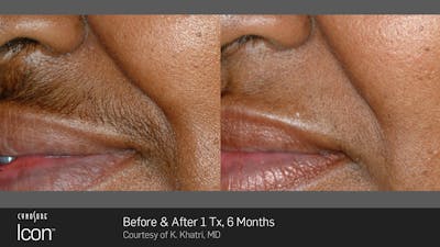 Laser Hair Removal Before & After Gallery - Patient 180415497 - Image 1