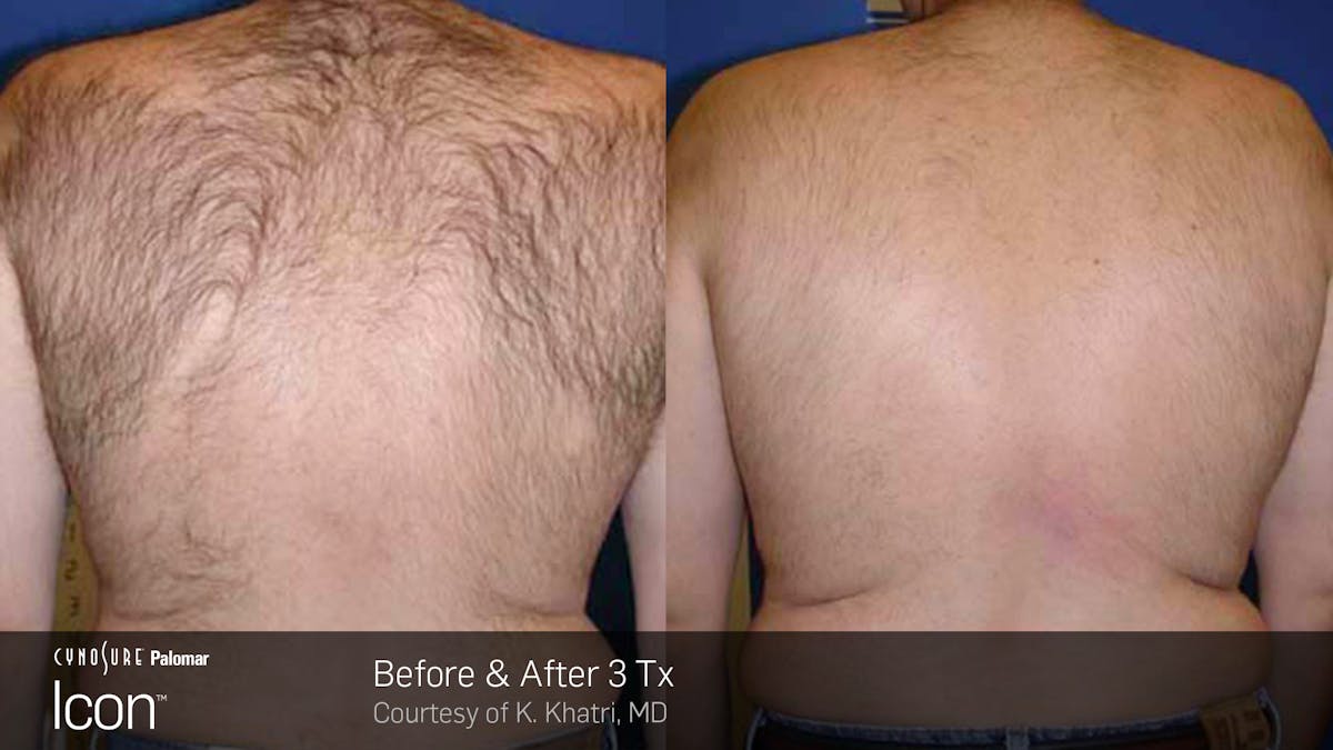 Laser Hair Removal Before & After Gallery - Patient 180415498 - Image 1