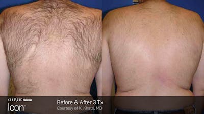 Laser Hair Removal Before & After Gallery - Patient 180415498 - Image 1