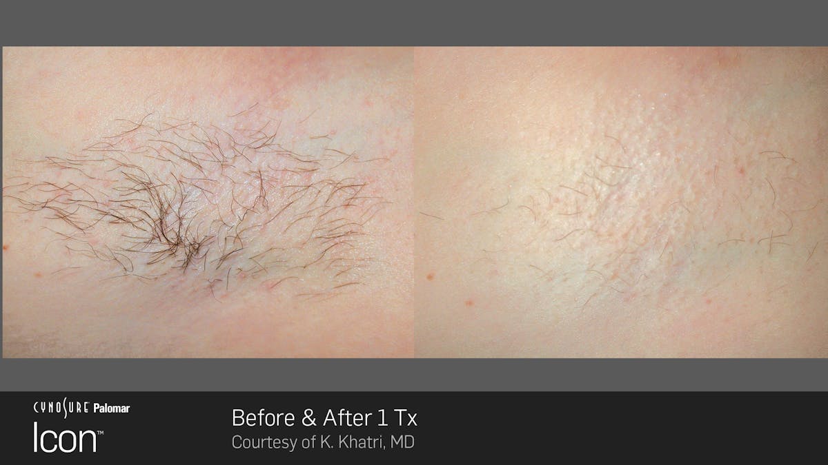 Laser Hair Removal Before & After Gallery - Patient 180415499 - Image 1