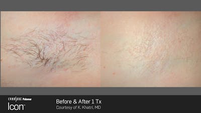 Laser Hair Removal Before & After Gallery - Patient 180415499 - Image 1