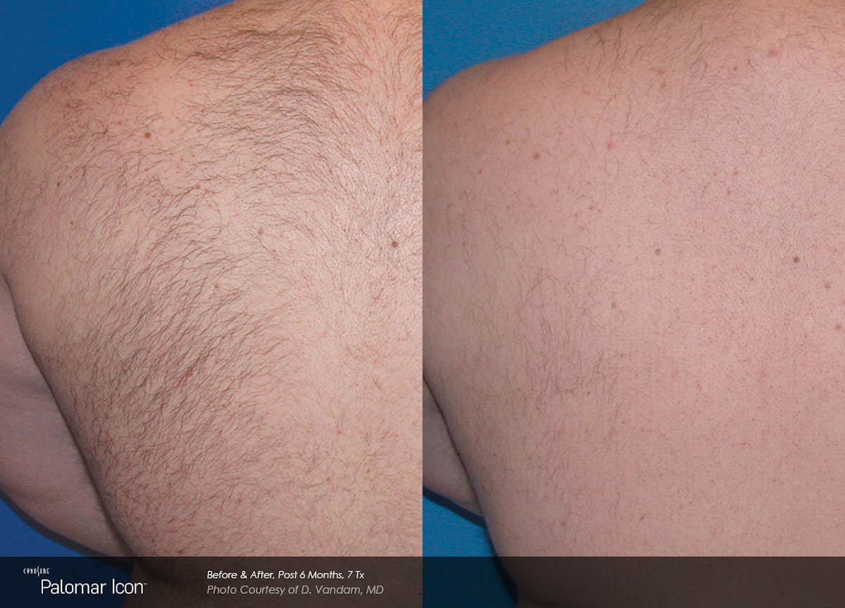 Laser Hair Removal Before & After Gallery - Patient 180415500 - Image 1